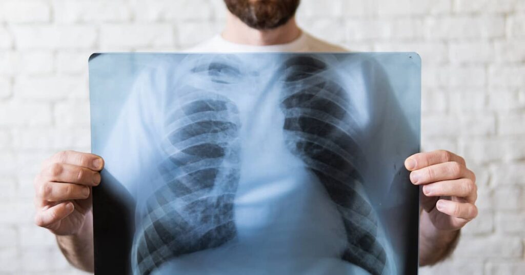 Young man with silicosis holding chest X-ray of diseased lungs | Henry Carus + Associates